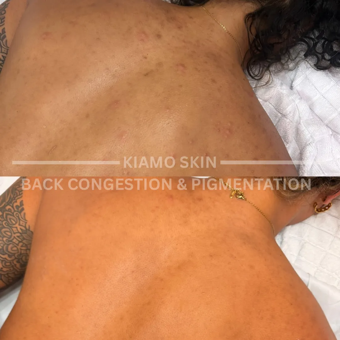 Back congestion and pigmentation before and after a course of treatment at KIAMO Skin