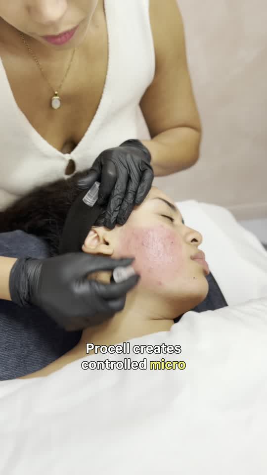 A gloved esthetician passing a Procell microchanneling handpiece across a client’s cheek